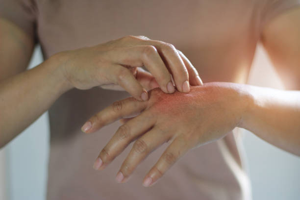 Techniques to Treat Skin Infections